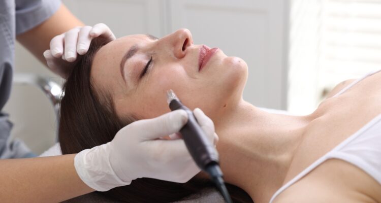 skin needling