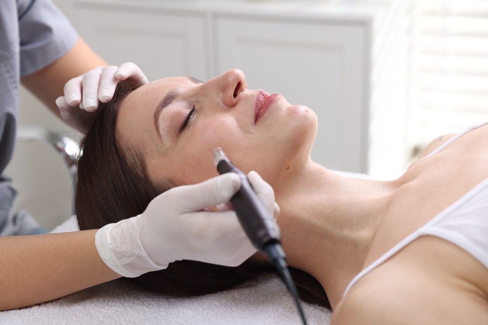 skin needling