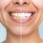 teeth whitening treatment