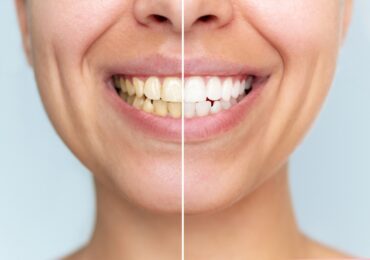 teeth whitening treatment