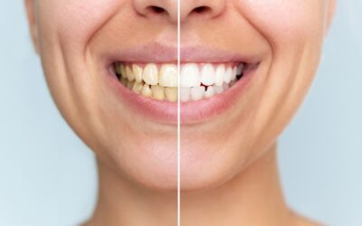 teeth whitening treatment