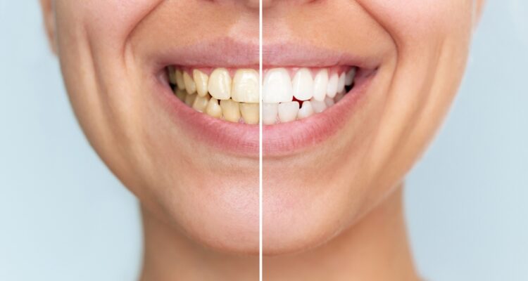 teeth whitening treatment