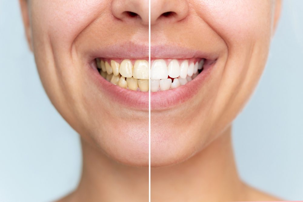 teeth whitening treatment