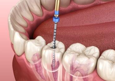 Root Canal Treatment