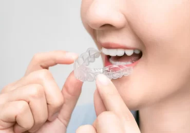 Clear Aligners Treatment in Bangalore