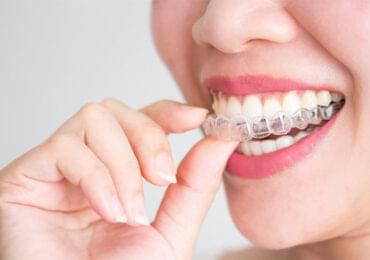 Invisalign Treatment at Richmond Dental Bangalore