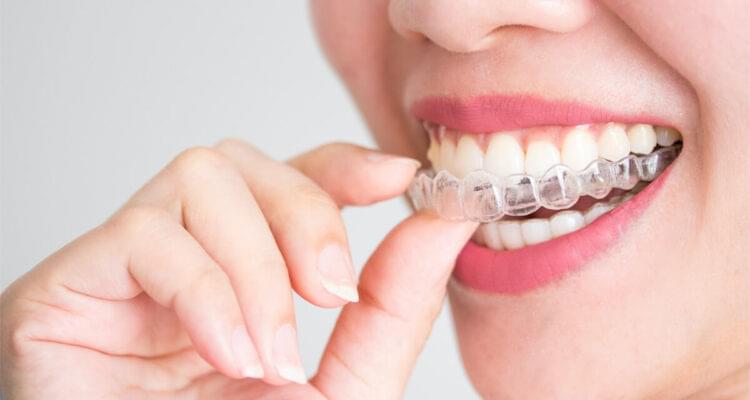 Invisalign Treatment at Richmond Dental Bangalore