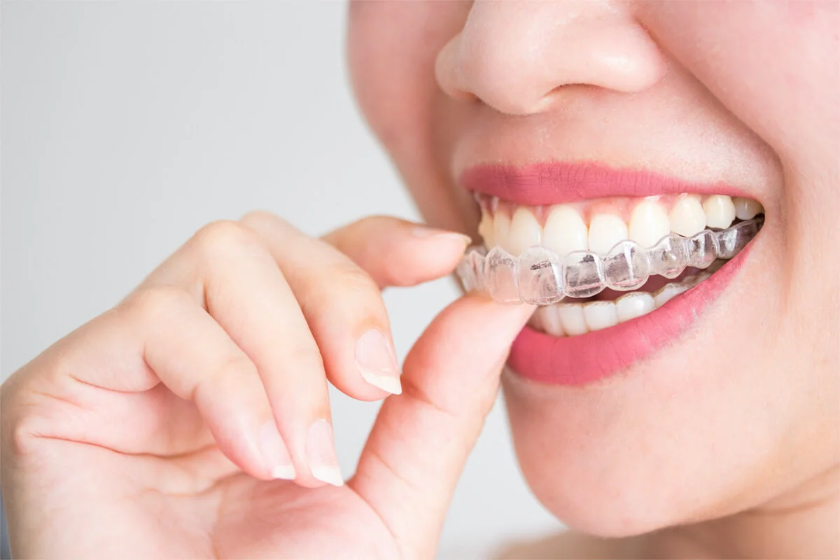 Invisalign Treatment at Richmond Dental Bangalore