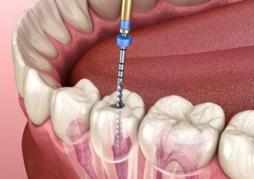 Painless Rootcanal Treatment