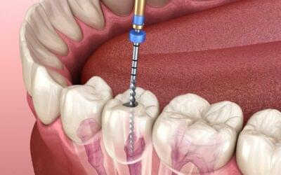 Painless Rootcanal Treatment