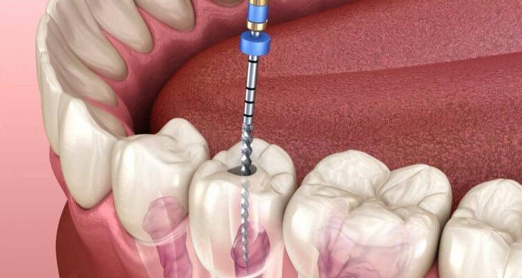 Painless Rootcanal Treatment