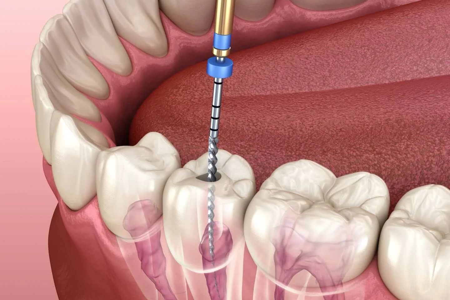 Painless Rootcanal Treatment
