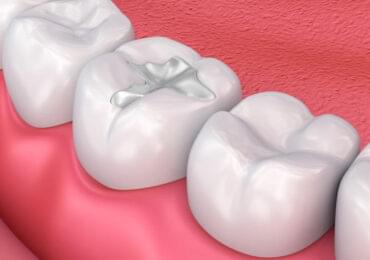 Best Cosmetic Dentistry in Bangalore